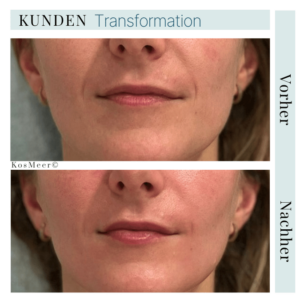 Alter: 34 Jahre | Resultat nach ästhetischer Gesichtsmassage: Vollere Lippen, geglättete Nasolabialfalten, glattere und strahlende Haut