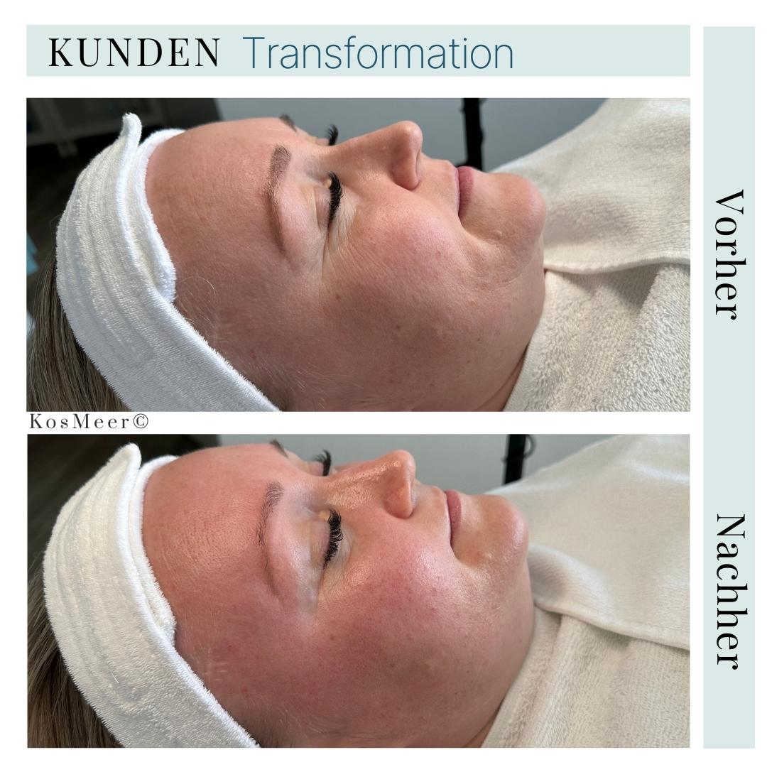 AQUA PEEL FACIAL & ÄSTHETISCHE AUGENMASSAGE