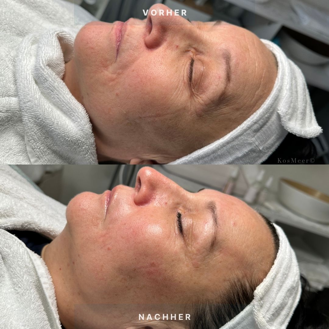 Kosmeer New Age Gesichtsbehandlung Gesichtsverjüngung ästhetische Gesichtsmassage KosMeer ©